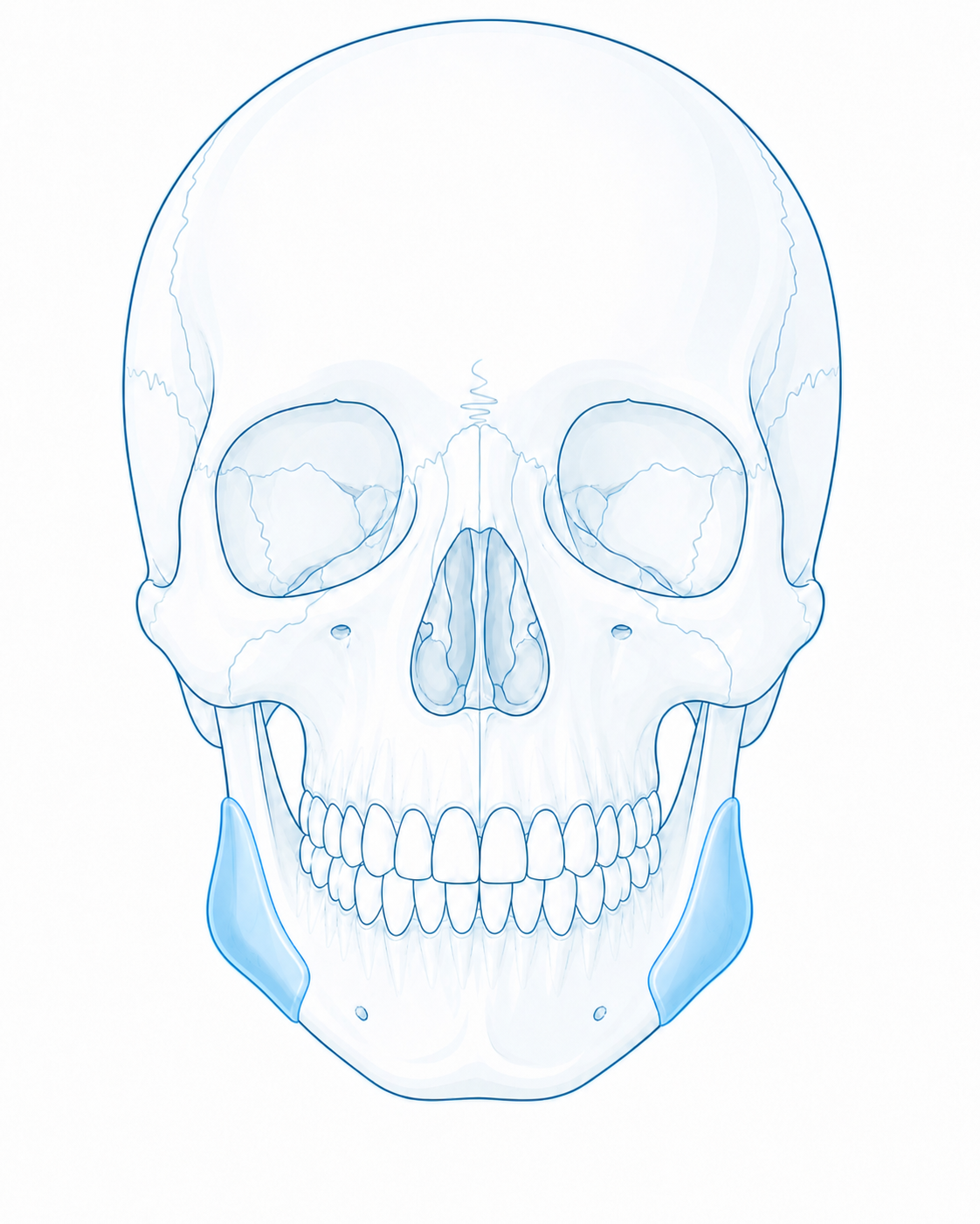 Frontal skull with gonial angle onlay