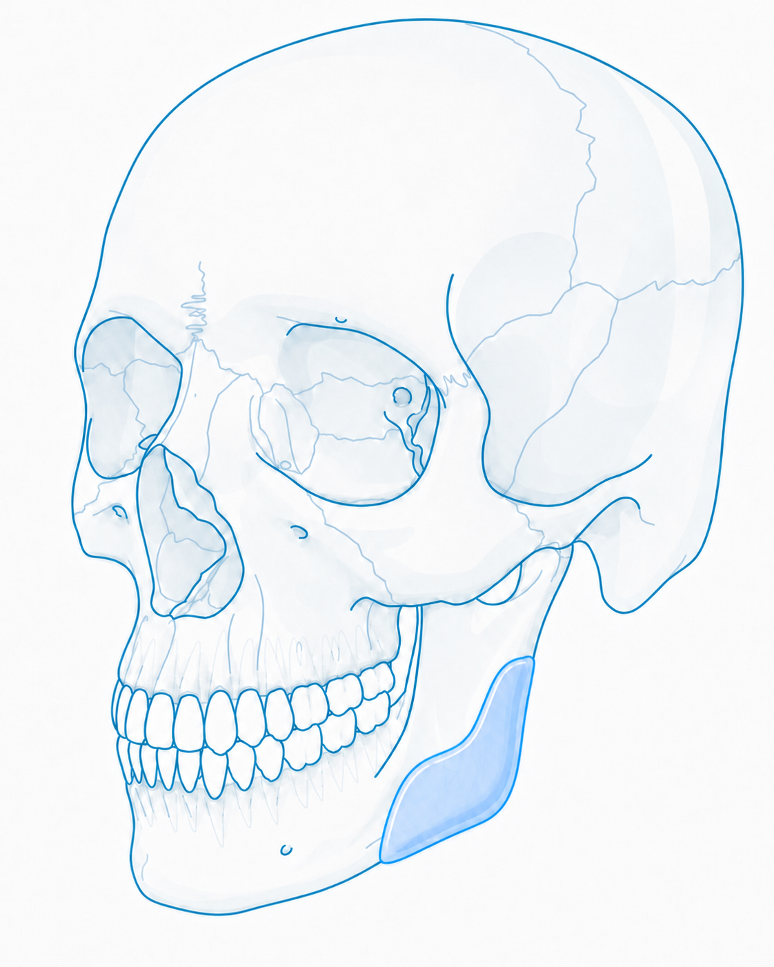 Lateral skull with gonial angle onlay