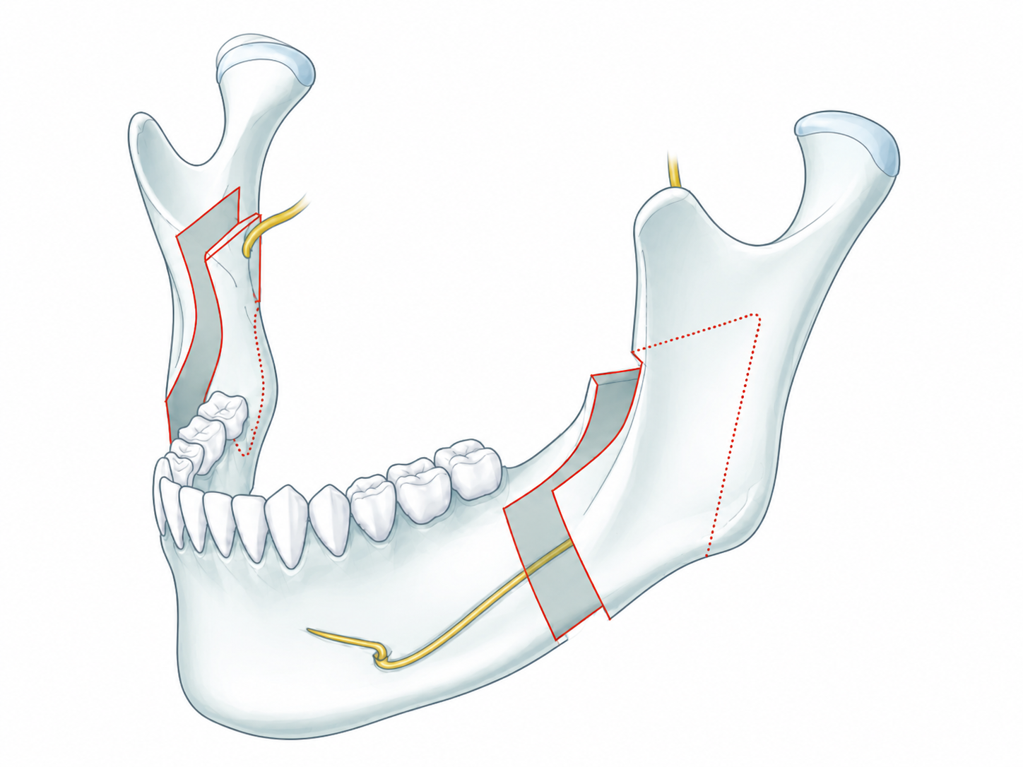 BSSO osteotomy design with inferior alveolar nerve course