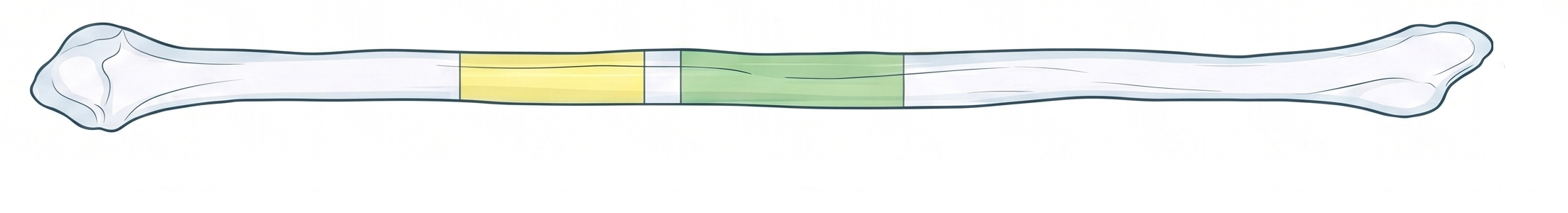 Fibula donor bone divided into planned reconstruction segments