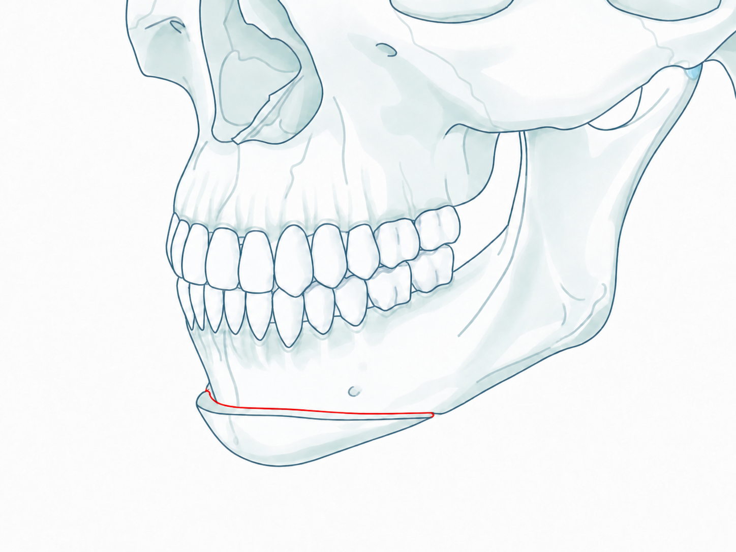 Genioplasty osteotomy cut line