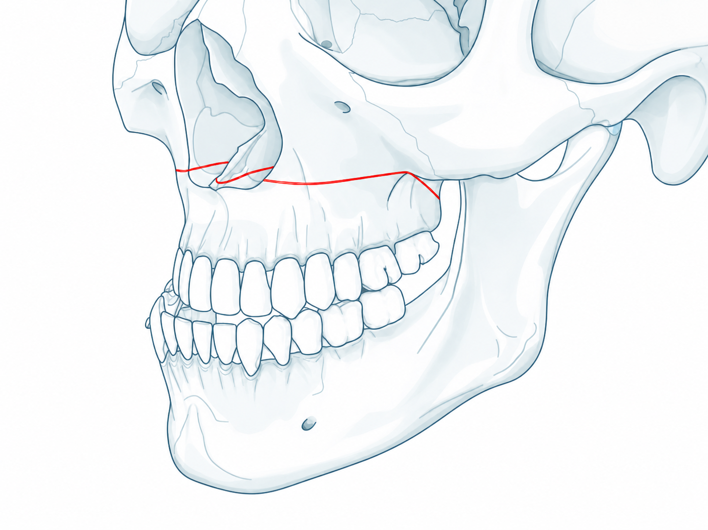 Le Fort I lateral osteotomy reference