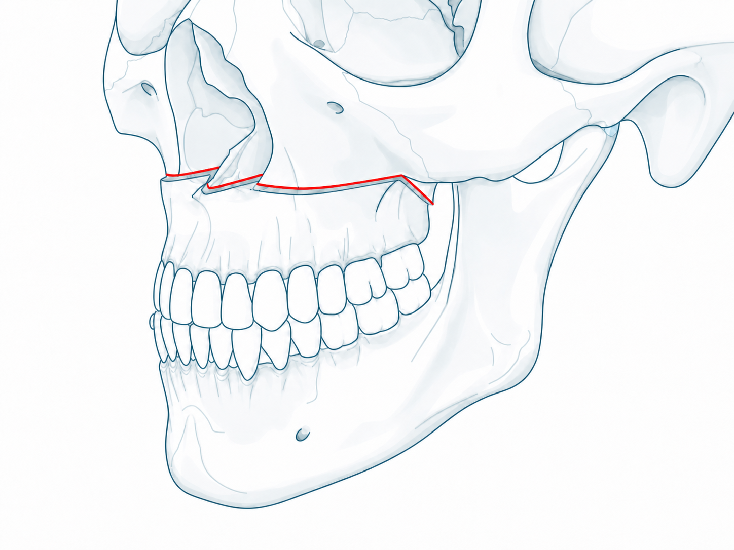 Le Fort I osteotomy line on the maxilla