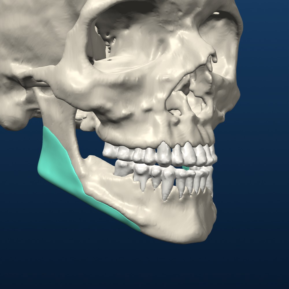 Mandibular angle onlay