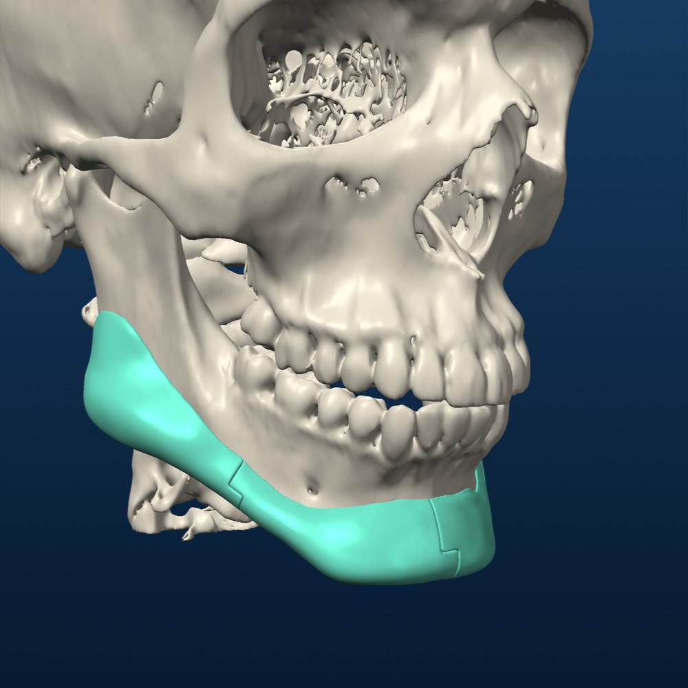 Wraparound mandibular onlay