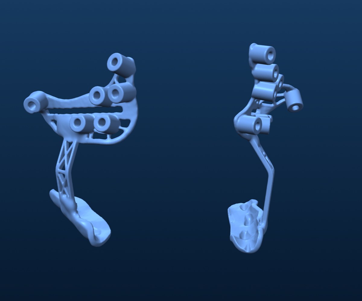 Cutting guides