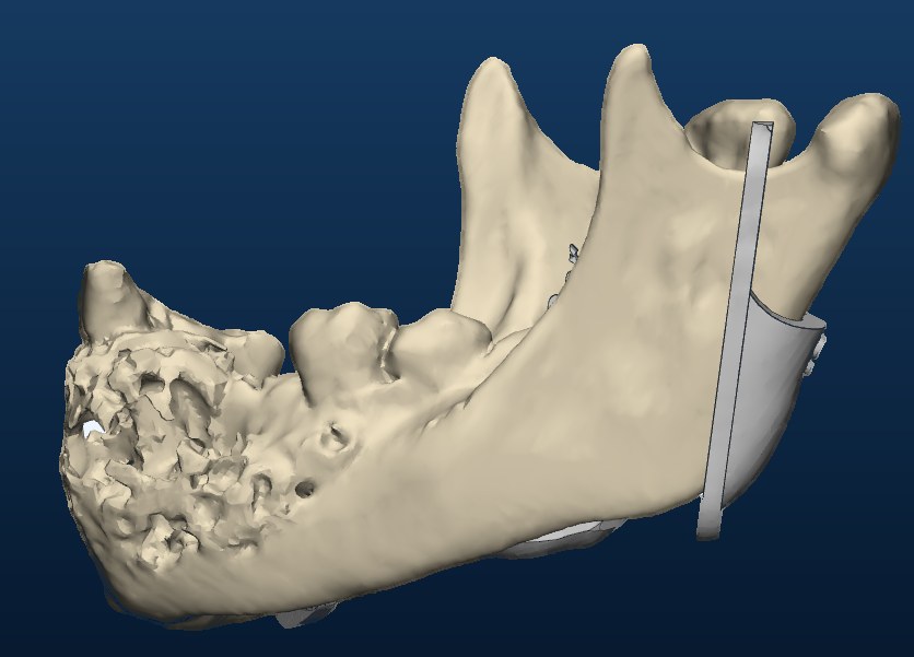 Cutting guide, left