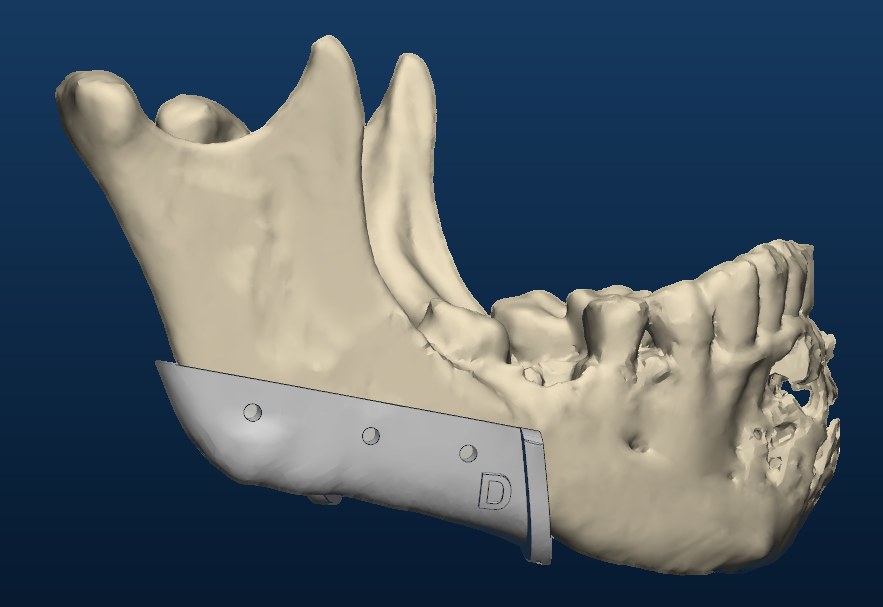 Cutting guide, right