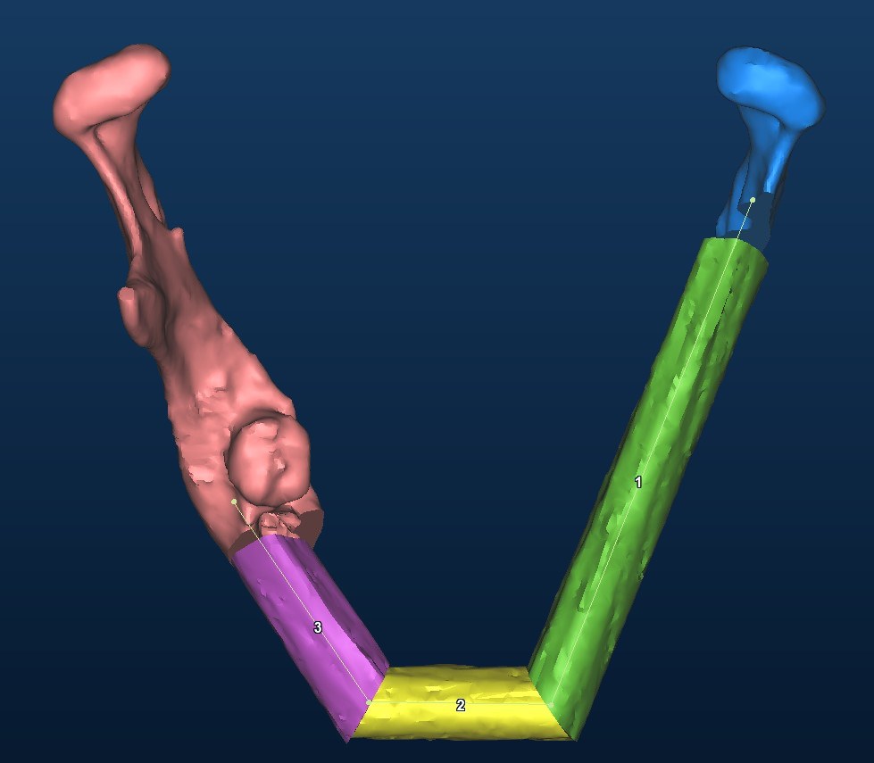 The plan: three fibula segments