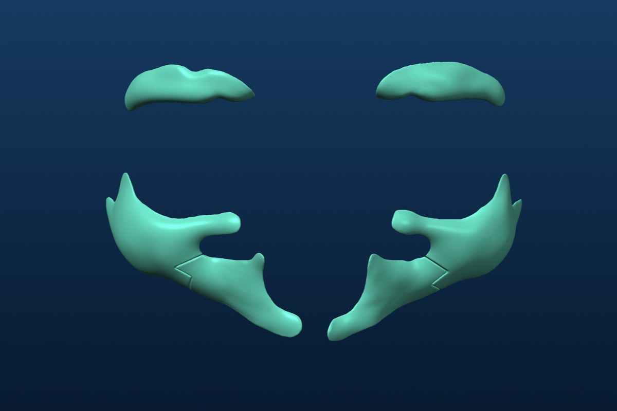The implants: supraorbital rim and malar, left and right