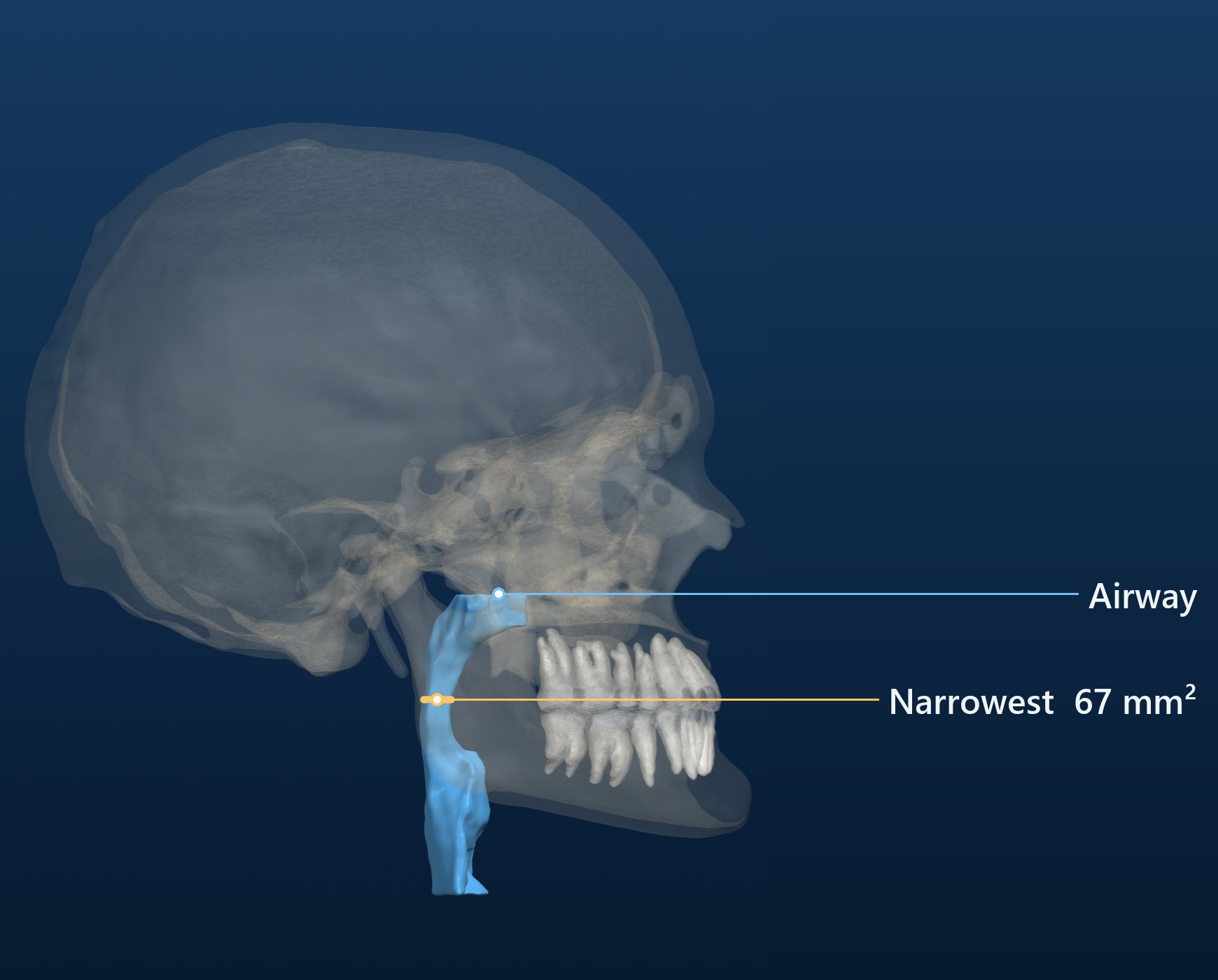 Airway, narrowest section marked