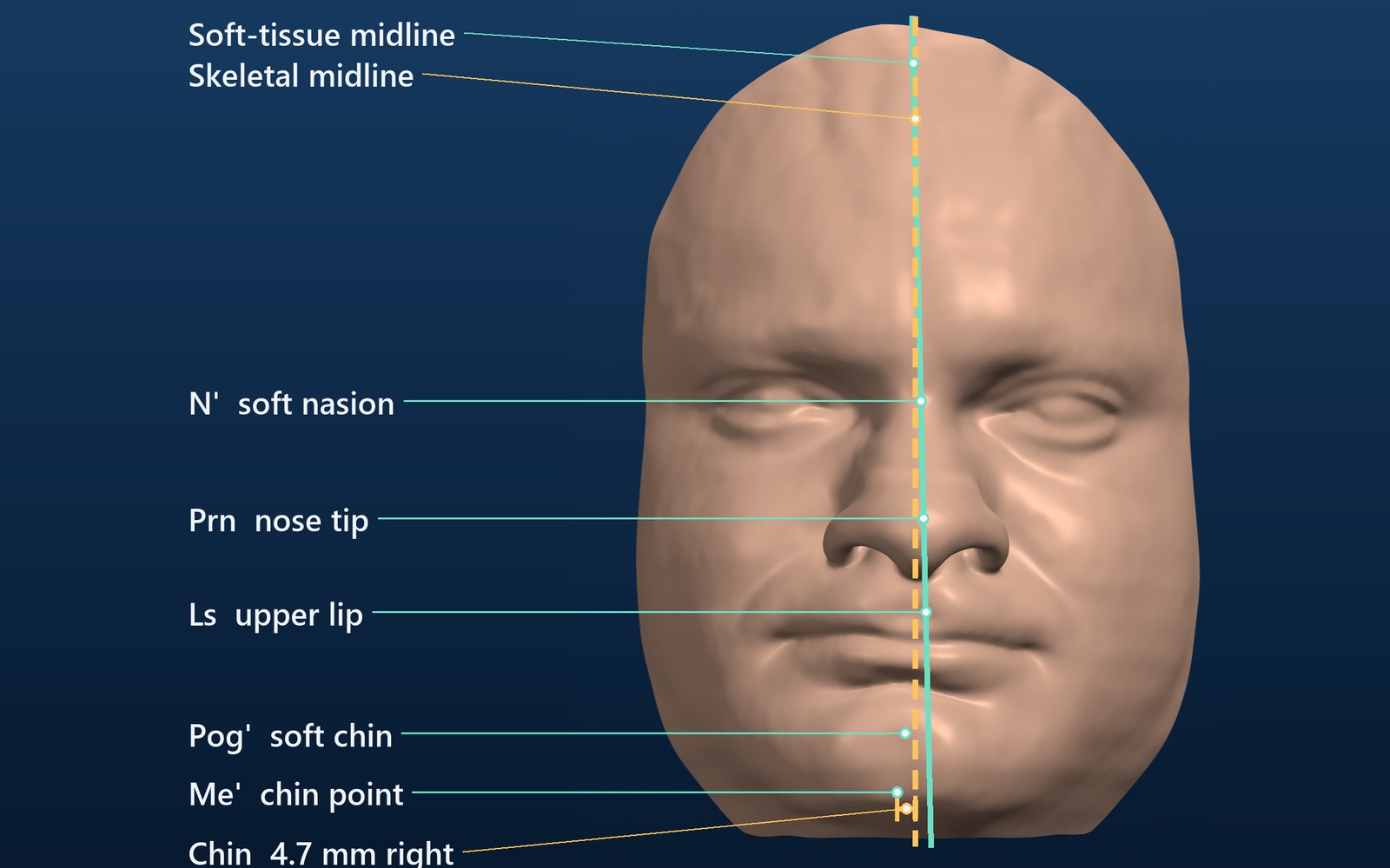 Face with landmarks and both midlines