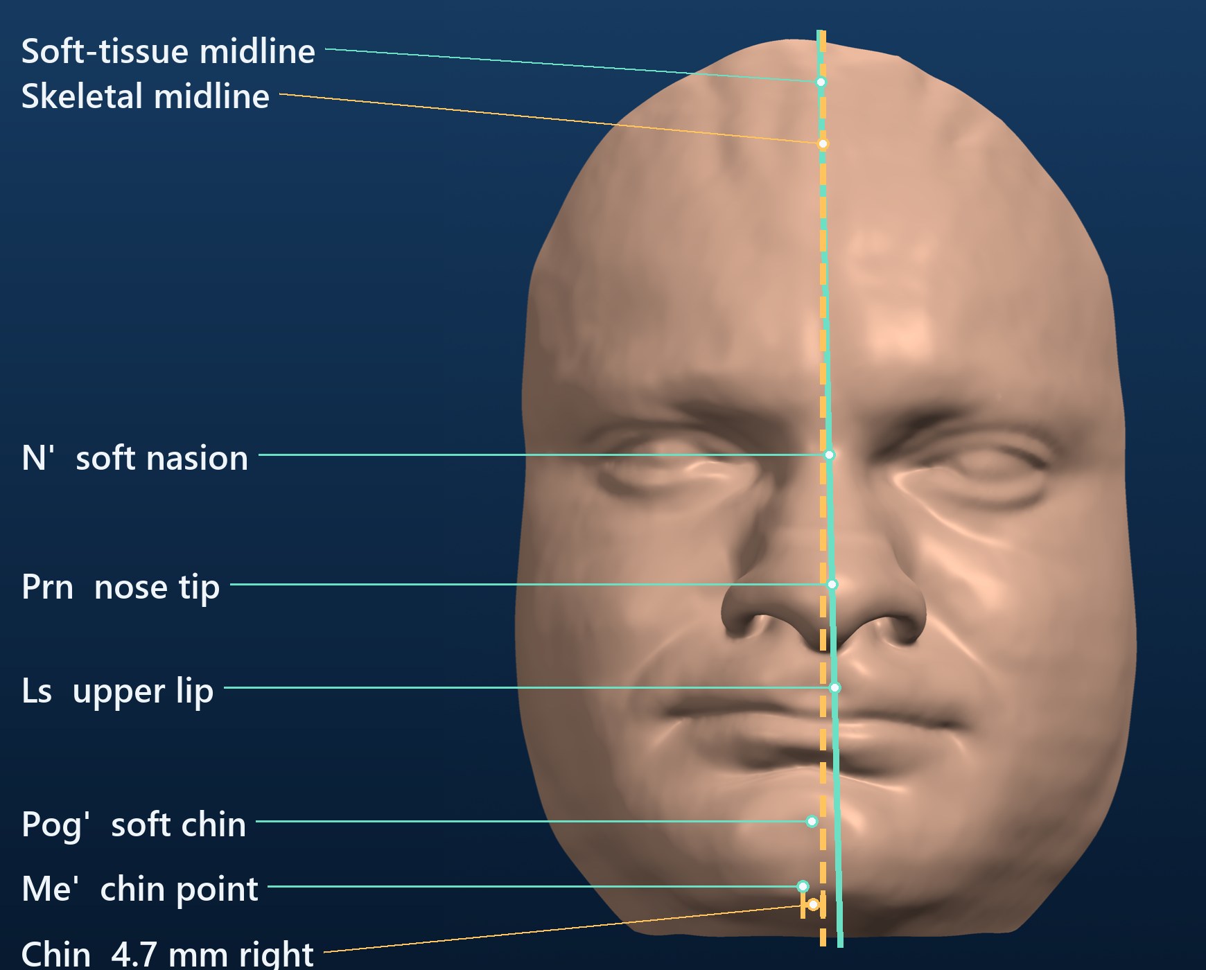 Landmarks, soft-tissue and skeletal midline