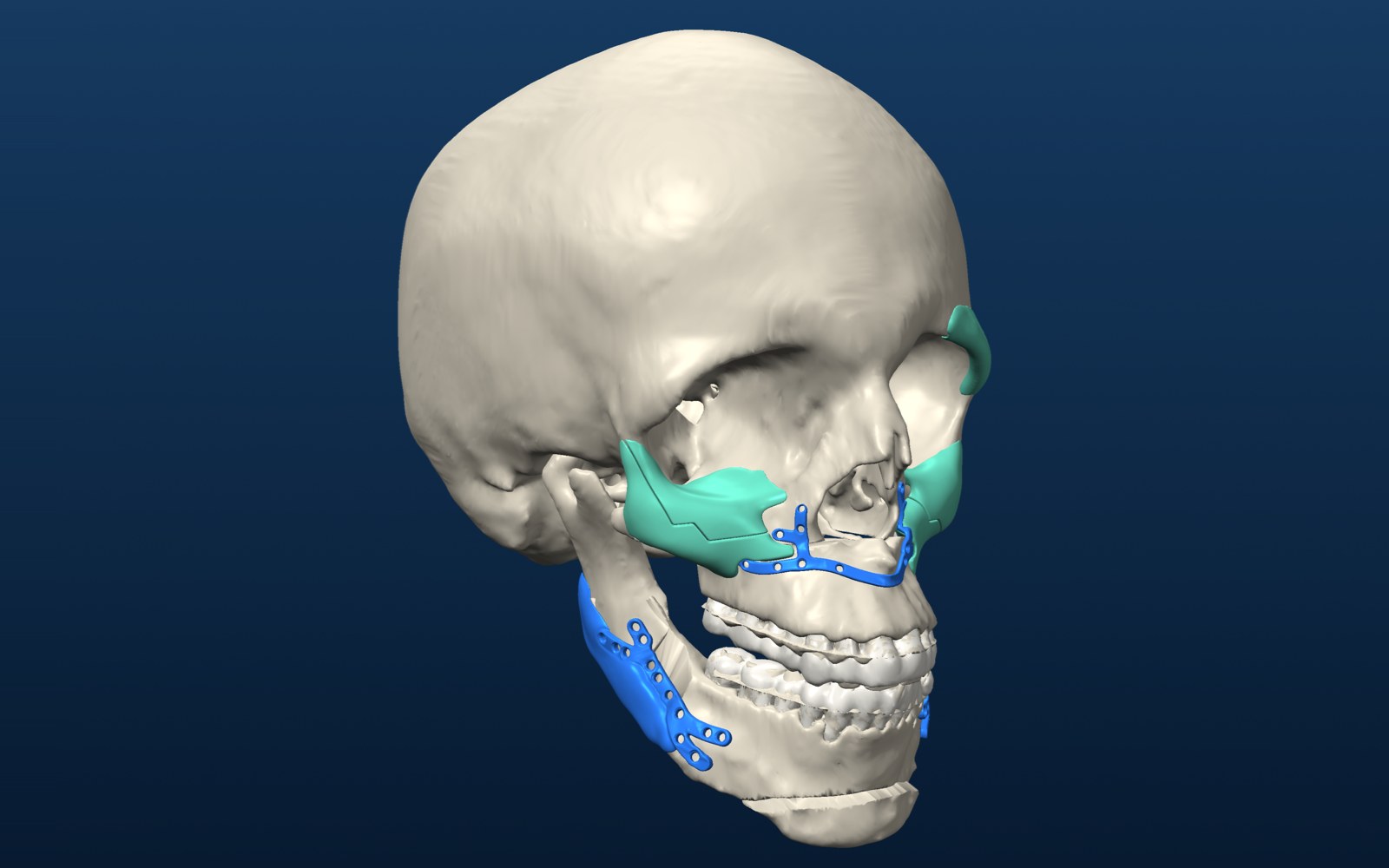 Planned bimaxillary surgery with plates and onlays