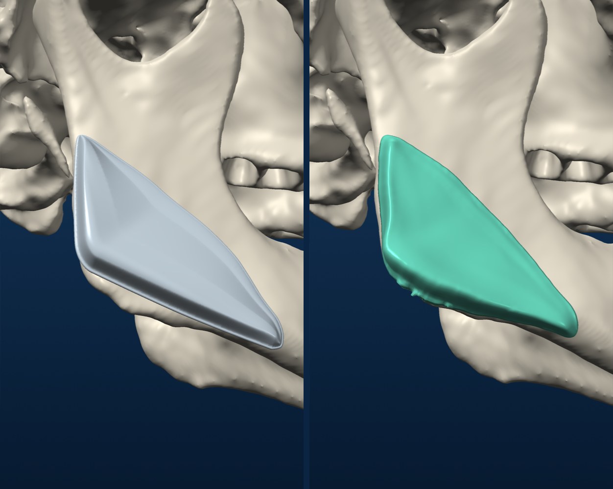 Stock shape, then fitted to the bone