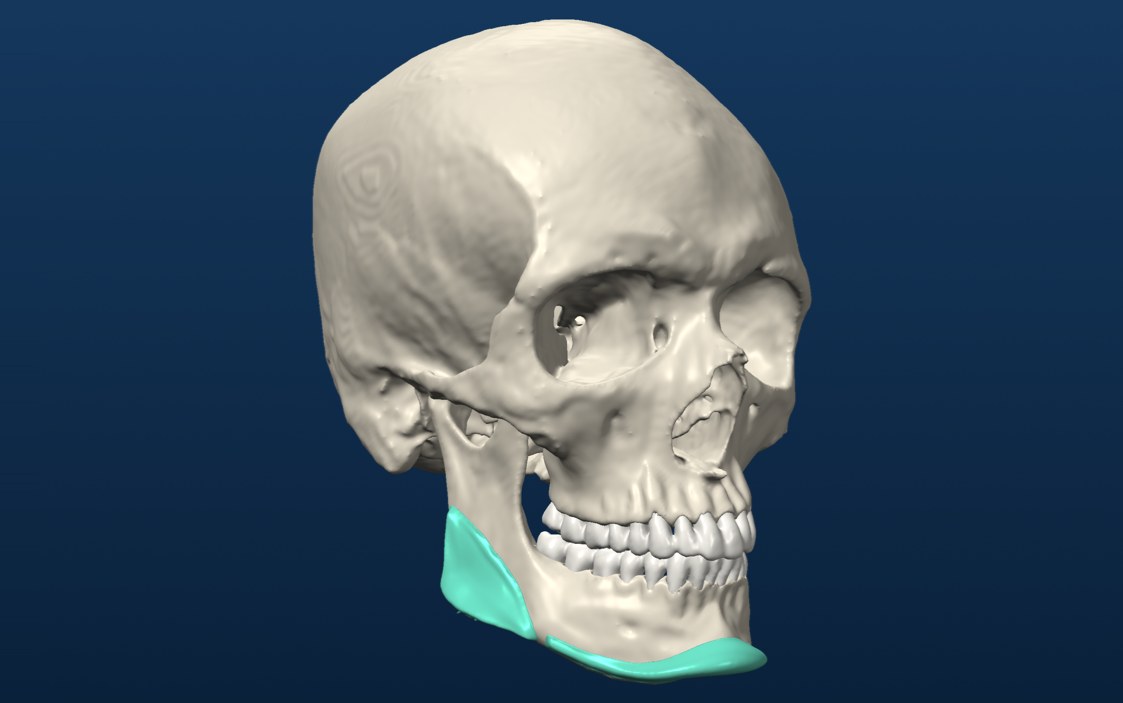 Silicone implants fitted on the jaw