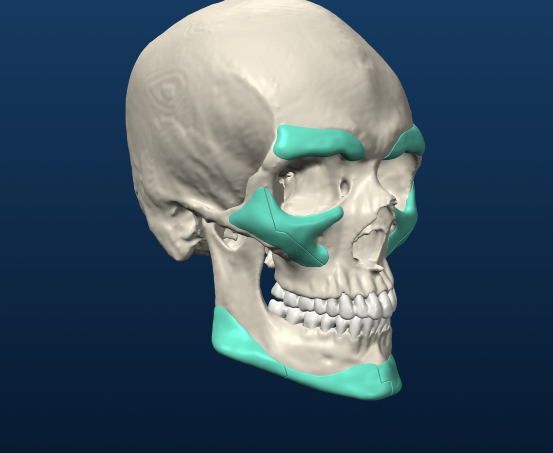The implants, right side
