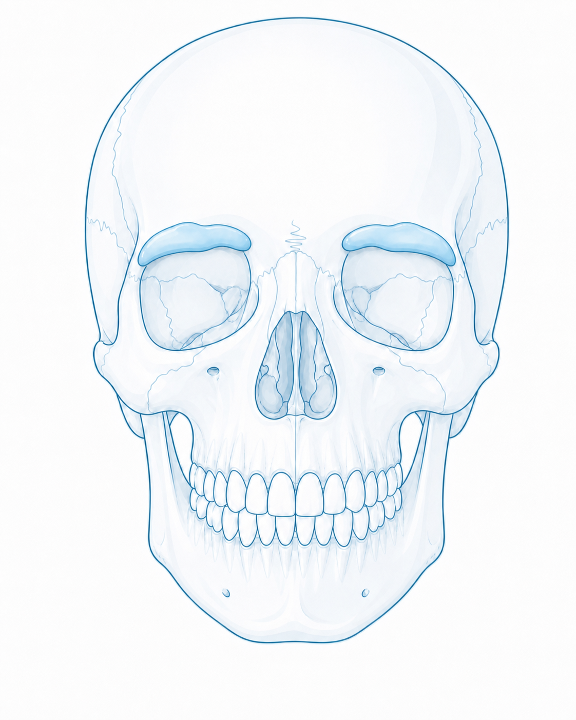 Frontal skull with supraorbital rim onlay