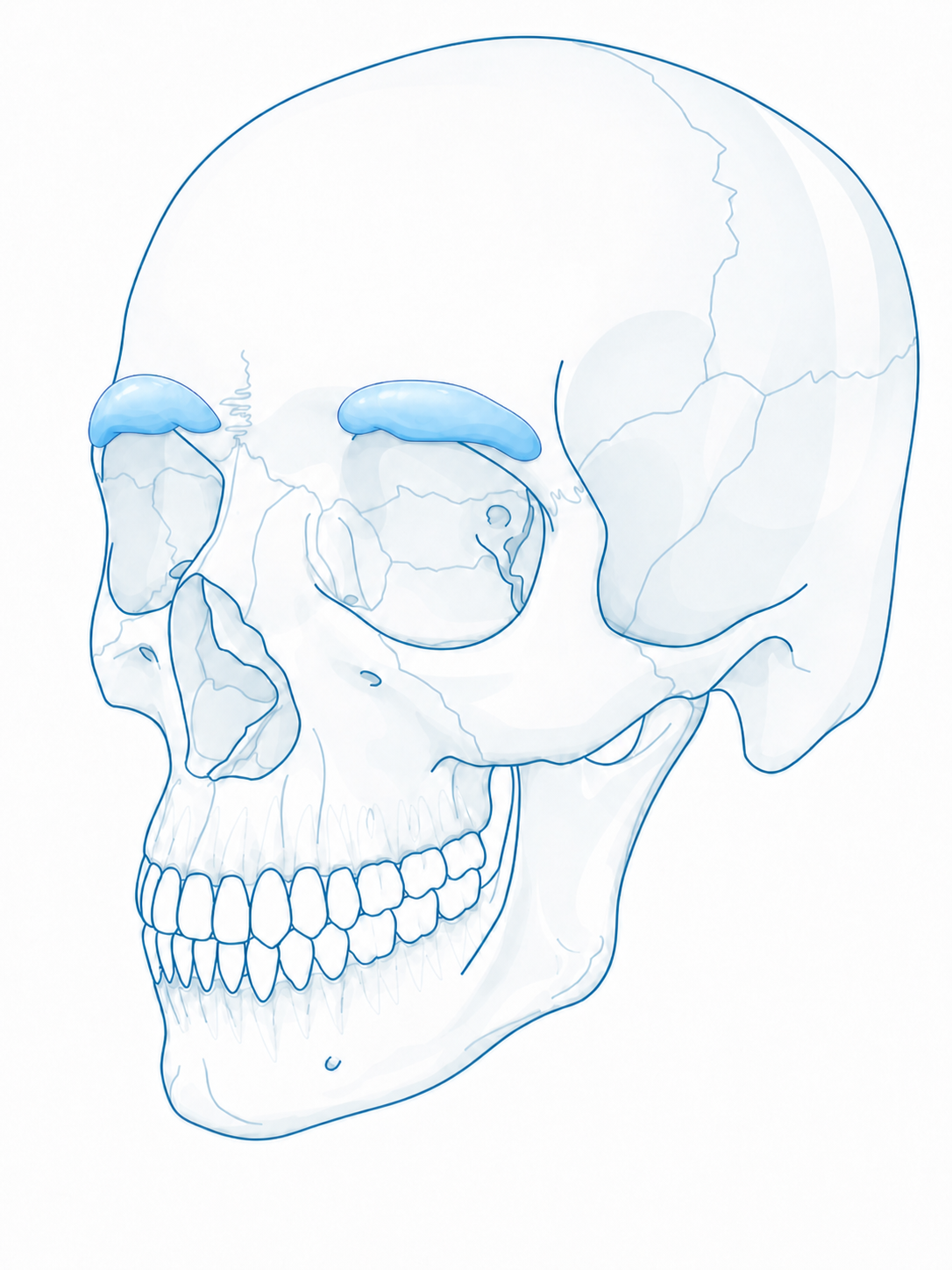 Lateral skull with supraorbital rim onlay