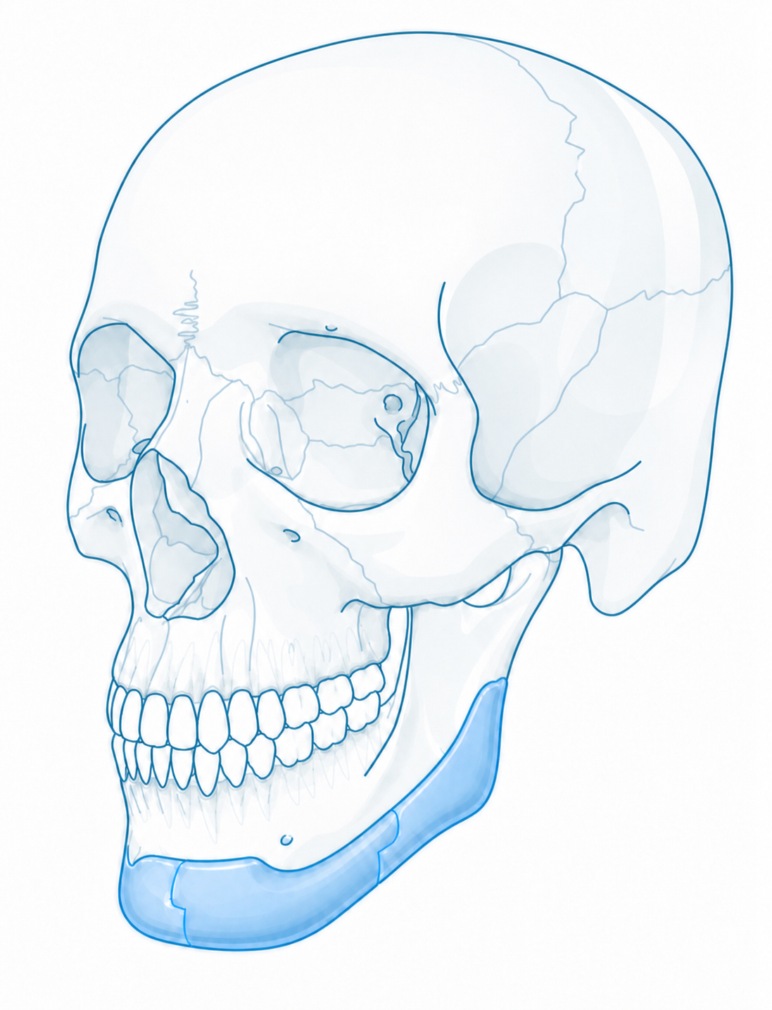 Lateral skull with wraparound mandibular onlay